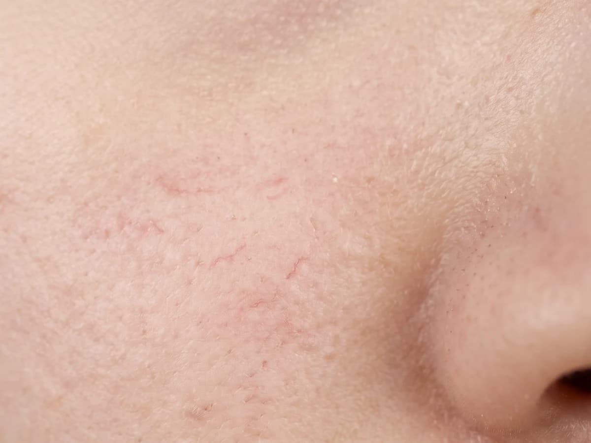 콧방울 옆 볼 피부에 옅은 붉은기와 가는 실핏줄이 은은히 비치는 매크로 사진