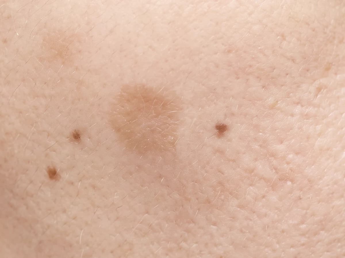 볼 피부의 납작한 갈색 반점과 작은 점들을 아주 가까이 본 사진