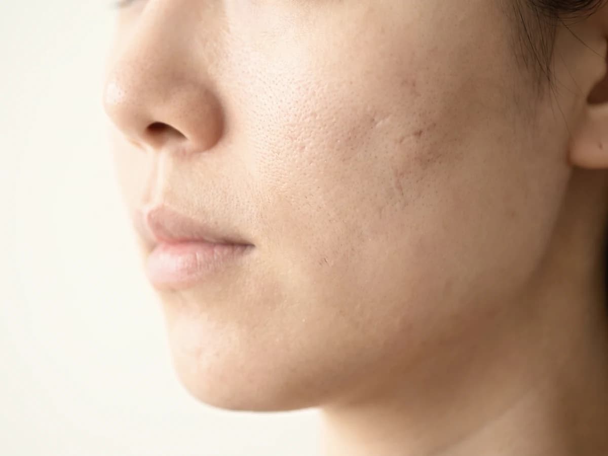 볼에 넓은 모공과 얕은 흉터 자국이 보이는 사진