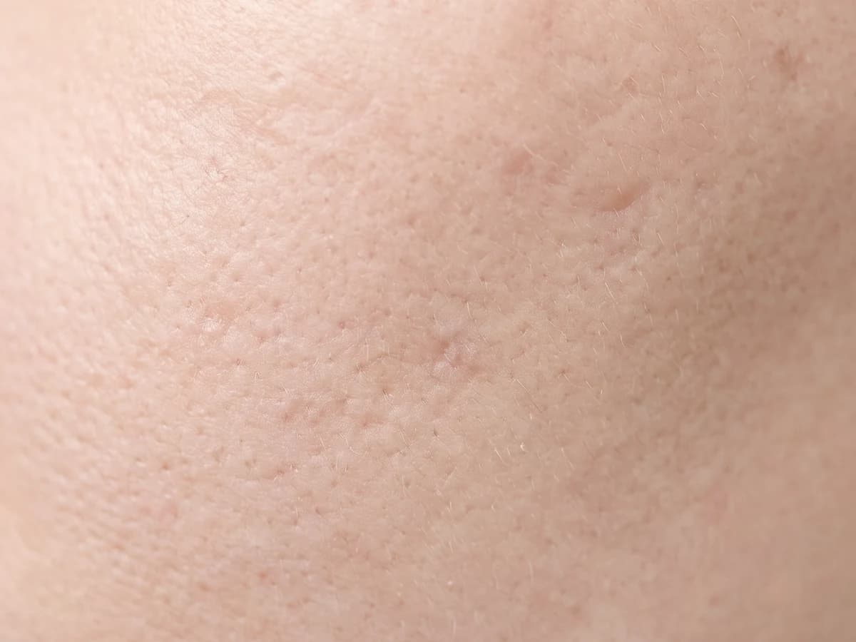 볼 피부에 넓어진 모공과 얕은 흉터 자국이 보이는 매크로 사진